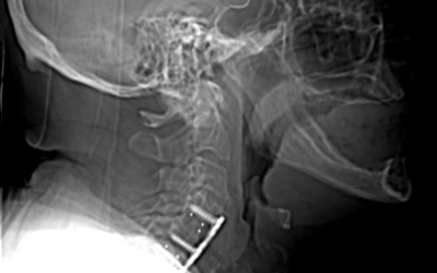 Dysphagia After Cervical Spine Surgery: C2-C7 Angle?