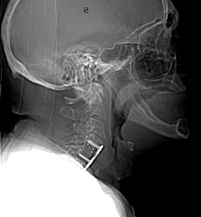 Dysphagia After Cervical Spine Surgery: C2-C7 Angle?