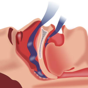Obstructive sleep apnea (OSA) image shows airflow coming in through the nose and mouth, but getting blocked by the back of the soft palate/uvula and the back of the tongue falling to the back wall of the throat when laying down flat for sleeping. 