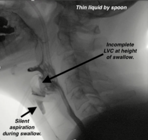 Videofluoroscopic Swallow Study (VFSS), aka Modified Barium Swallow Study (MBSS) on a person post-lung transplant with numerous complications. This VFSS was done 3 weeks after the lung transplant. This x-ray image shows reduced laryngeal vestibule closure, meaning that there is poor airway protection. This allows penetration to aspiration during the swallow with thin liquid sip by spoon. There was no response to this large volume of aspiration (seen here below the vocal cords along the anterior tracheal wall). That is a silent aspiration in a "gross" amount. 