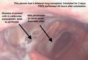 Fiberoptic endoscopic examination of swallowing image of pharynx on right side, laryngeal vestibule and vocal cords. See residue of milk after the swallow pooling in pharynx and spilling into the larynx, penetrating to the level of the vocal cords. Will aspirate after the swallow.