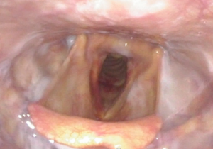 another photo of the bilateral lung transplant larynx, including red vocal cords and trachea from intubation trauma. Milk penetrating to level of the vocal cords. 