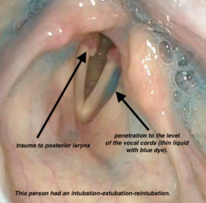 FEES image of a person who is post-lung transplant. See trauma to the posterior larynx from multiple intubations. Has penetration to the level of the vocal cords that will likely lead to an aspiration.