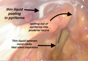 FEES image close up of the spilling of milk out of the pyriforms and into the larynx posteriorly. Also with milk between vocal cords, falling to a silent aspiration (PAS 8).