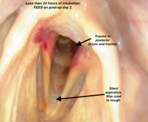 Fiberoptic endoscopic examination of swallowing image of laryngeal vestibule and vocal cords. See redness in posterior larynx and vocal cords. See aspiration anteriorly just below the vocal cords.