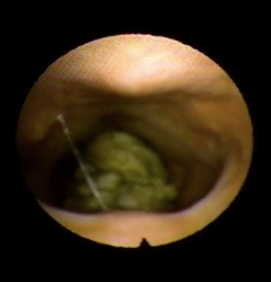 This is a still image from the FEES (endoscopic image) swallow study that shows the of the back wall of the throat/pharynx at the top of the photo and the tongue base and the front of the throat at the bottom of the photo. You see a glob of partially chewed bread that has fallen into the top of the airway (into a space called the laryngeal vestibule). Since that is above the level of the vocal cords, the person could still cough forcefully to eject it if there is good sensation and respiratory effort to do so.
