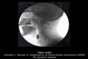 Image demonstrates choking risk with poorly chewed ball of bread. This is the side view of a modified barium swallow study (aka, videofluoroscopic swallow study) with a large ball (bolus) of bread falling into the top of the airway (the laryngeal vestibule).