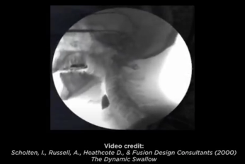 Image demonstrates choking risk with poorly chewed ball of bread. This is the side view of a modified barium swallow study (aka, videofluoroscopic swallow study) with a large ball (bolus) of bread falling into the top of the airway (the laryngeal vestibule). This is important knowledge this dysphagia awareness month.