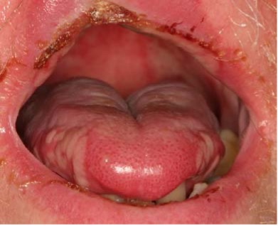 this is a mouth, showing lips, tongue and palate that are red, inflamed, and have painful sores that make it hard to eat and drink. This is an example of mucositis, which is one factor that can exacerbate radiation-associated dysphagia. 