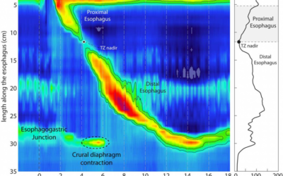 Deep Dive into Esophageal Dysphagia + 10 Questions