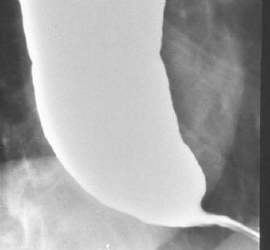 Barium Swallow picture reminds SLP's to screen the esophagus during a Modified Barium Swallow. This liquid could come back up (retrograde flow) and cause aspiration.