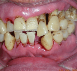 Periodontitis with bone loss and gum recession can result from poor oral hygiene.