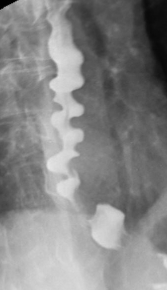 Image from a Barium Swallow of diffuse esophageal spasm, where the bolus remains in the esophagus. High risk for the bolus to return to pharynx and cause aspiration.